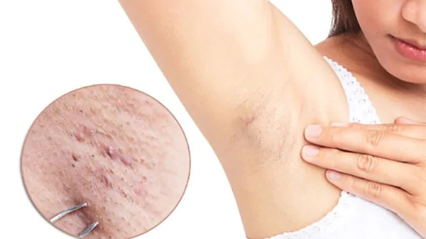 alt: Hình ảnh minh họa nguyên nhân viêm nang lông ở nách do mặc áo bó sát, gây bí bách và cọ xát vùng da dưới cánh tay