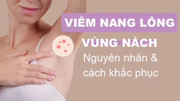 alt: Hình ảnh viêm nang lông ở vùng da dưới cánh tay, thể hiện tình trạng da sưng đỏ và có mụn nhỏ li ti
