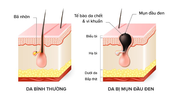 alt text: Hình ảnh minh họa lỗ chân lông bị tắc nghẽn