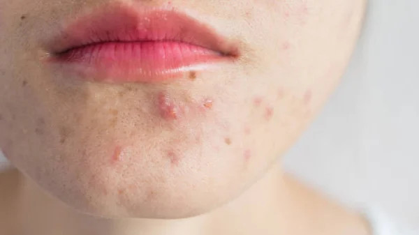 Có nhiều nguyên nhân dẫn đến sự hình thành mụn dưới cằm