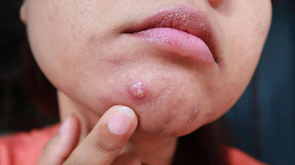Mụn bọc ở dưới cằm là loại mụn phổ biến