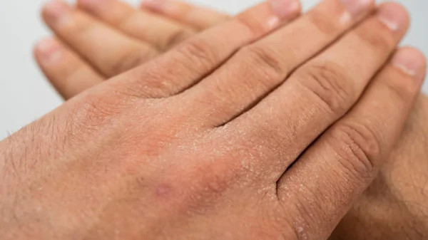 tại sao cần chăm sóc da tay mùa hanh khô, lý do nên chăm sóc da tay mùa hanh khô