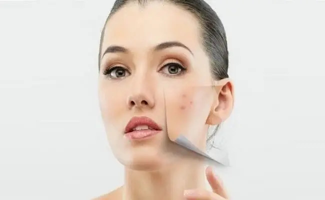 Vì sao da khô mụn cần được dưỡng ẩm