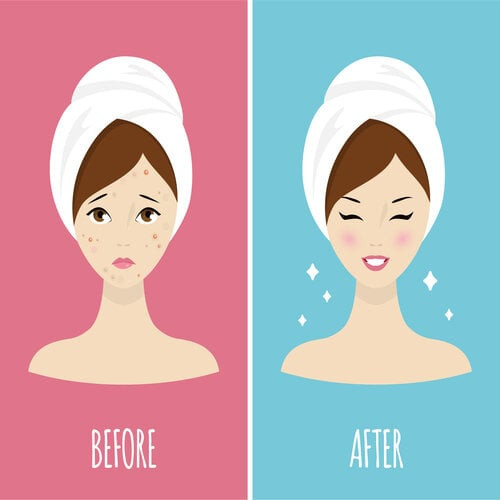AHA hỗ trợ điều trị mụn