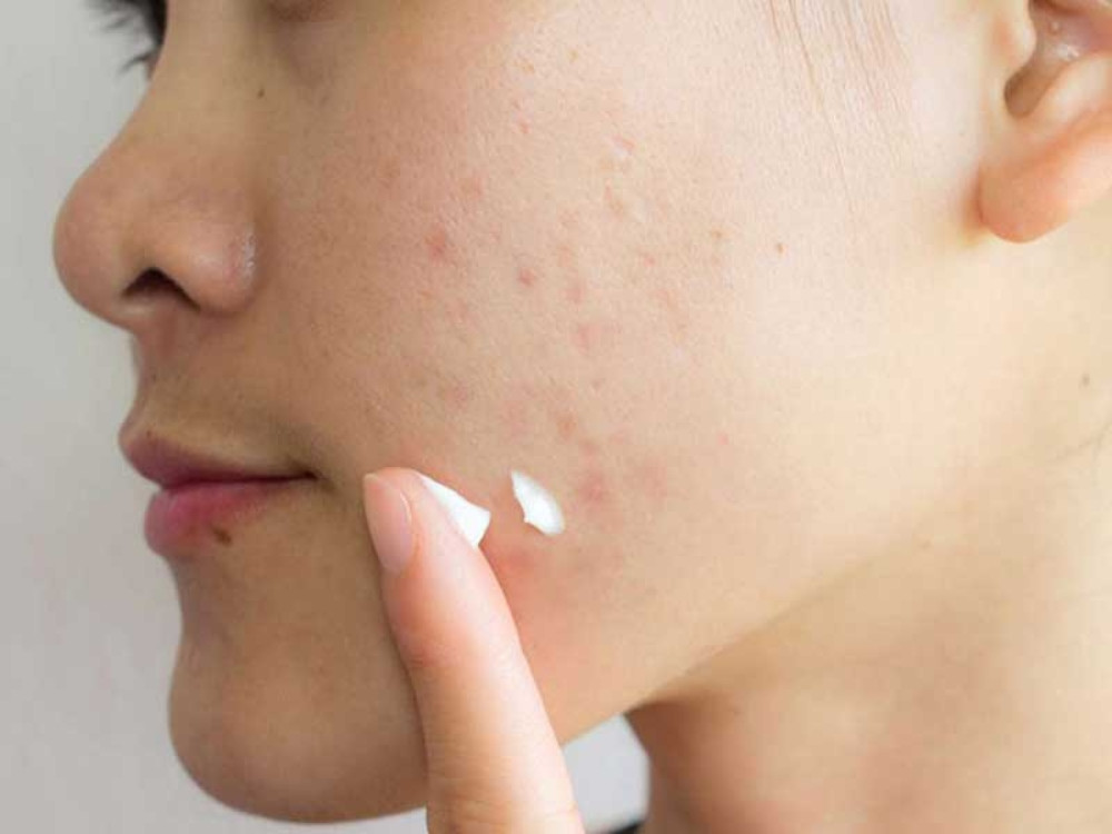 Bôi kem trị sẹo giúp da trị sẹo rỗ mau lành và không để lại sẹo
