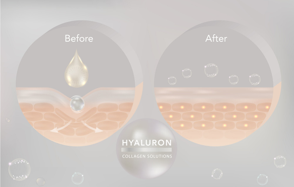 Hyaluronic acid và 5 công dụng làm đẹp da tuyệt vời