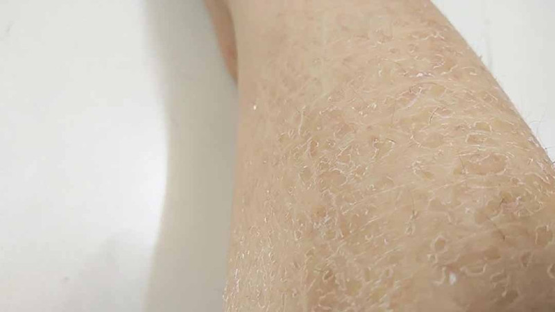 Da chân bị tróc vảy trắng: Dấu hiệu, nguyên nhân và cách xử lý hiệu quả
