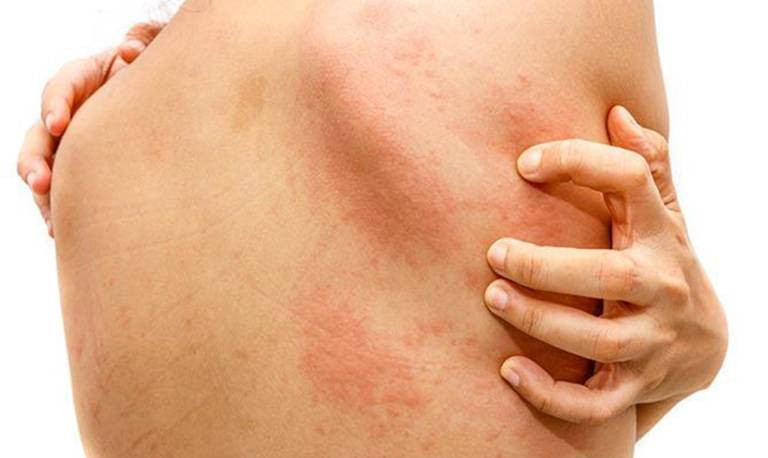 DỊ ỨNG NỔI MỀ ĐAY CÓ ĐÁNG LO NGẠI?