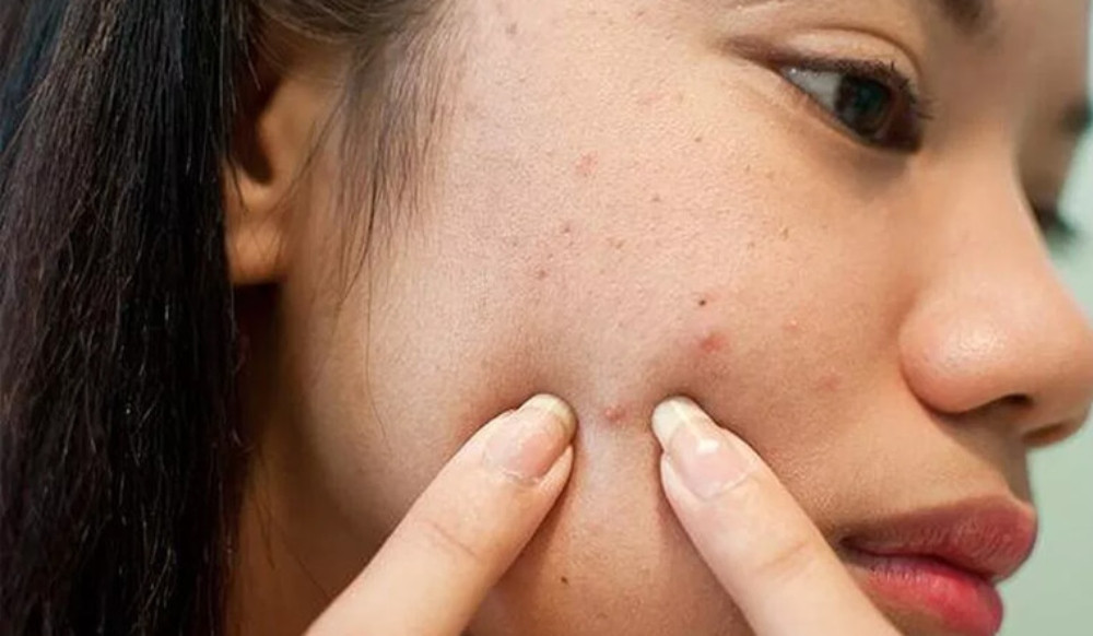 Hạn chế sờ tay lên mặt để tránh viêm nhiễm