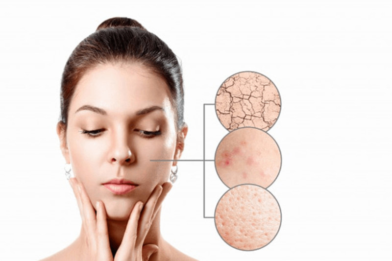 Nguyên nhân gây khô da và nổi mụn ẩn