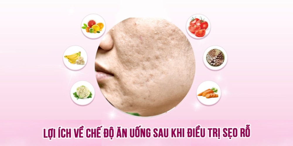 Những loại thực phẩm nên ăn sau khi điều trị sẹo rỗ