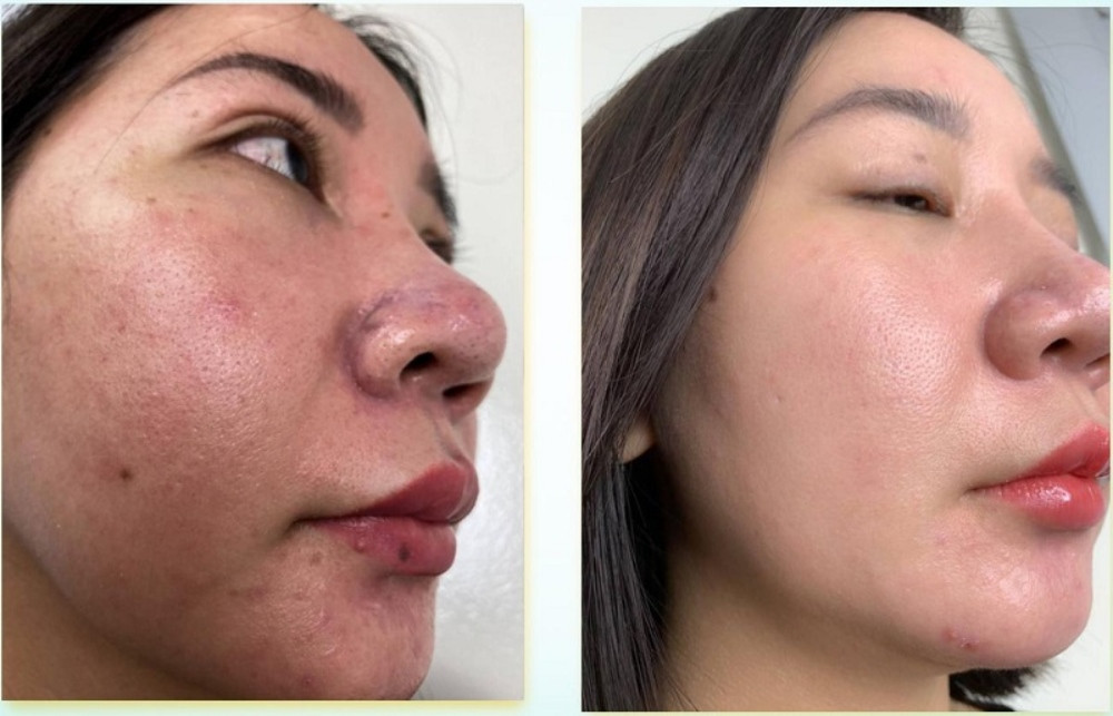 Những lưu ý chăm sóc da sau khi bóc tách sẹo