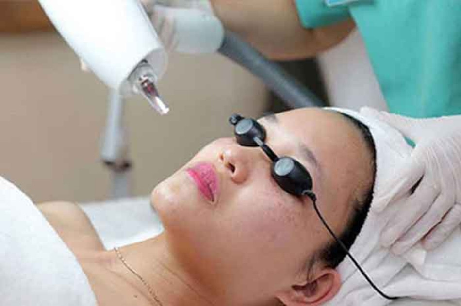 Phương pháp laser trị nám