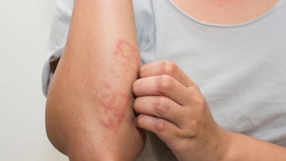 Rau má hỗ trợ điều trị các bệnh lý về da như chàm, vảy nến