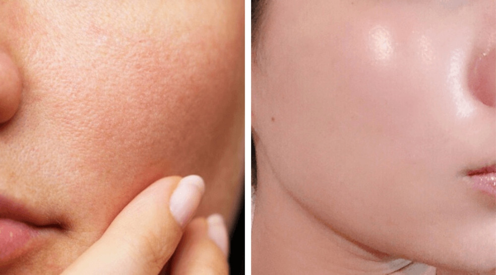Sử dụng kem dưỡng da để giúp se khít lỗ chân lông