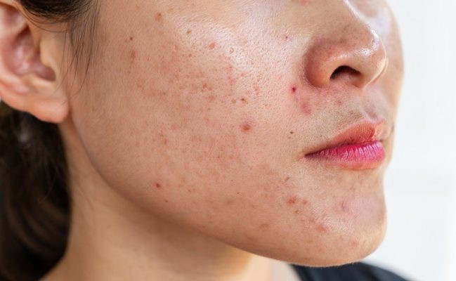 Tại sao cần phải phục hồi da sau mụn?