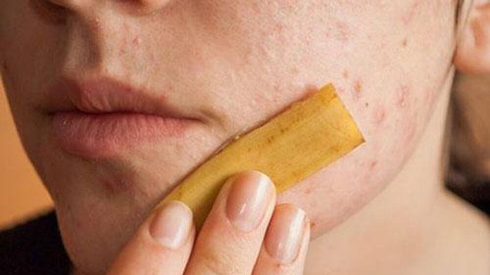 Cách sử dụng vỏ chuối trị mụn an toàn nhất