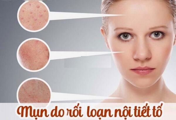 Những Cách Điều Trị Mụn Nội Tiết Hiệu Quả Bạn Nên Biết