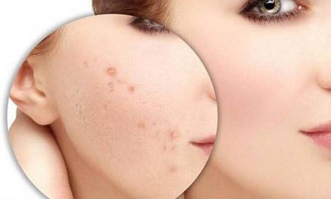 Cách Xử Lý Mụn Ẩn Dưới Da: Nguyên Nhân và Phương Pháp Điều Trị Hiệu Quả