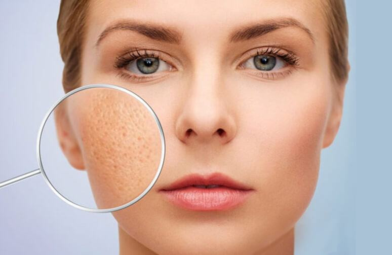 Sẹo rỗ: Nguyên nhân, dấu hiệu và phương pháp điều trị hiệu quả
