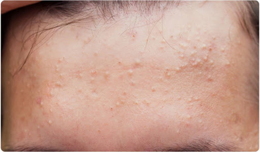 Sản Phẩm Trị Mụn